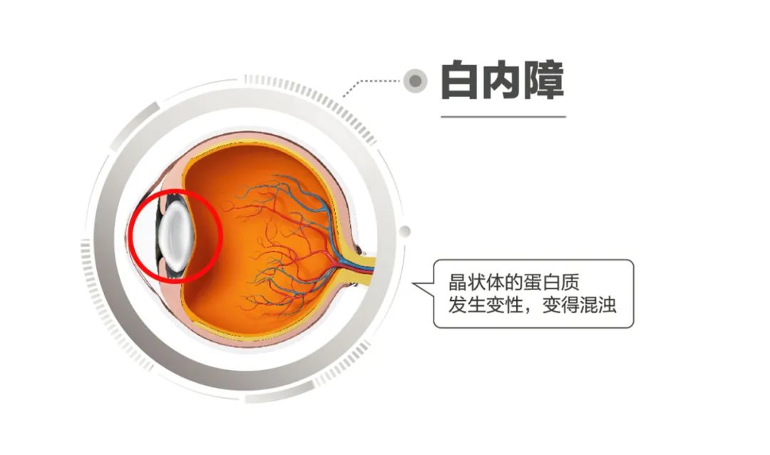 都看不清，那老花眼、白内障如何区分？